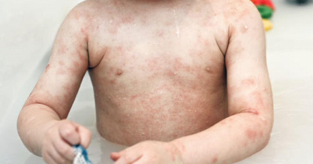 Ekzém - léčba, příznaky, domácí recepty | Zdravopedie.cz