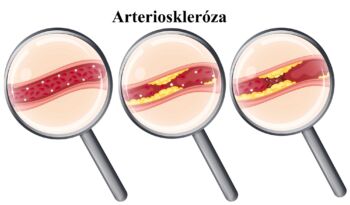 Arterioskleróza