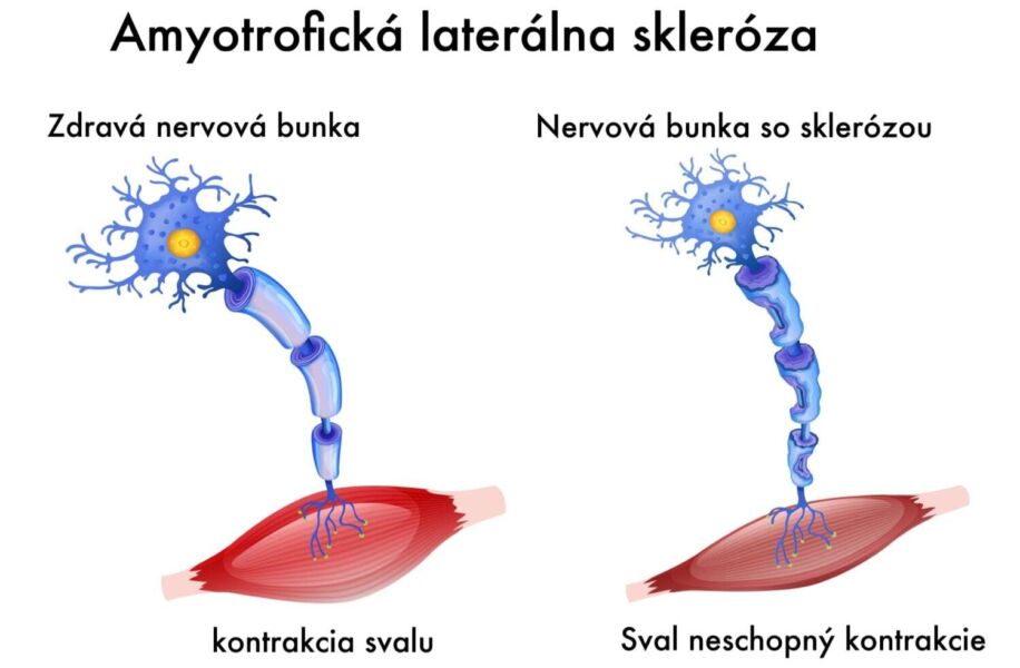 amyotrofická laterálna skleróza
