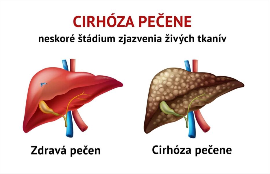 Pečeňová cirhóza