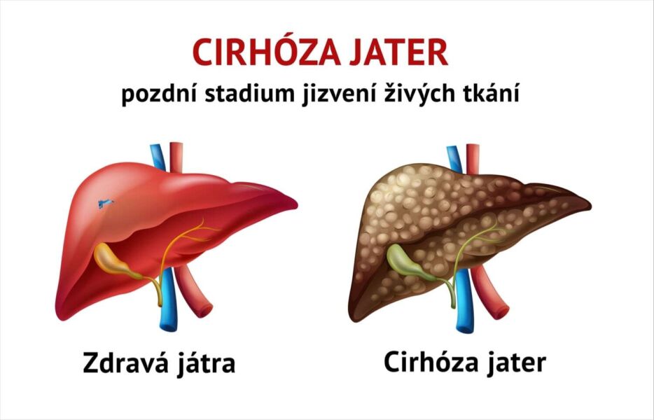 Cirhóza jater