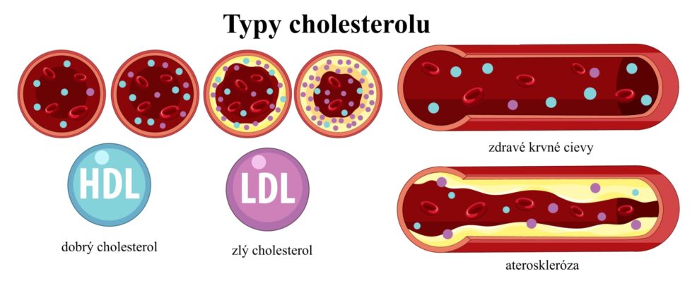 Hyperlipidemia4