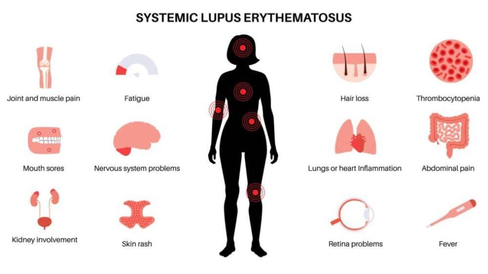 příznaky lupusu, zdroj: arthritiswa.org.au