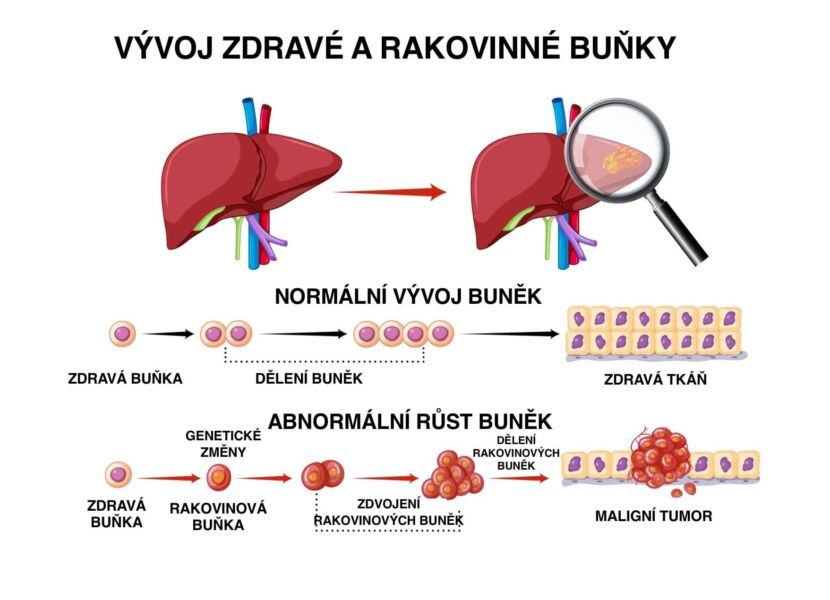 Vývoj rakovinových buněk jater