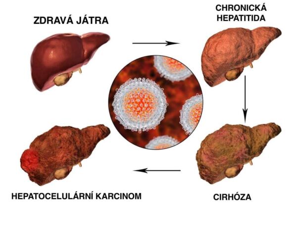 Průběh chorobného procesu