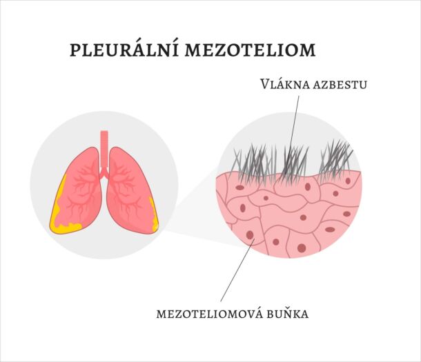 Mezoteliom