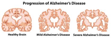 Atrofie mozku u pacienta s Alzheimerovou chorobou