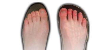 Hallux valgus (vybočený palec) - prevencia