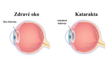 Katarakta - příznaky