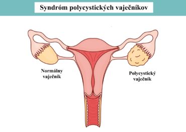 Syndróm polycystických vaječníkov - diagnostika