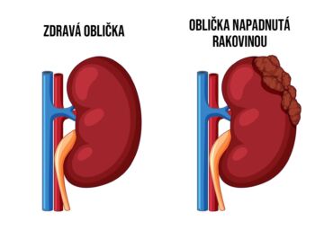 Rakovina obličky