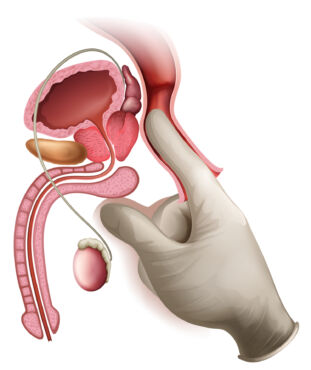 Vyšetření prostaty přes konečník
