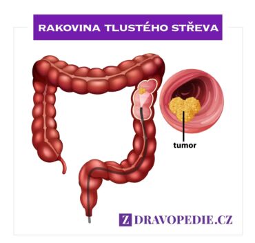 Rakovina tlustého střeva