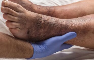 Stázová dermatitida - příznaky