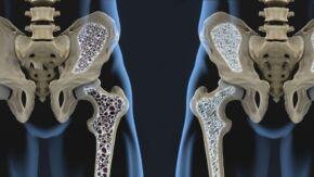 Tvaroh udržuje zdravé kosti a pomáhá léčit osteoporózu
