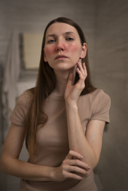 Woman dealing with rosacea skin condition face min