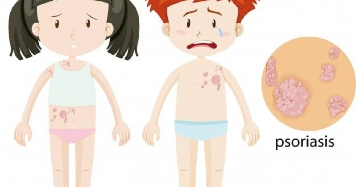 Psoriáza u detí - liečba, príznaky, domáce recepty | Zdravopedia.sk