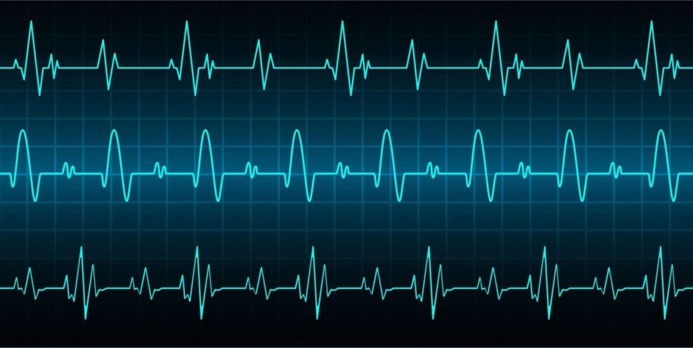 EKG monitoring