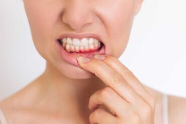 Orálne probiotiká Streptococcus salivarius pomáhajú znížiť zápal ďasien