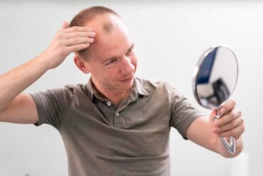 Strata vlasov je najčastejším príznakom alopecia areata.