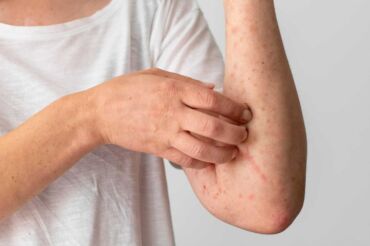 Alergia na vajcia vs.