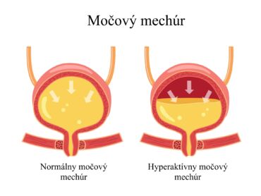 Prečo hyperaktívny močový mechúr vzniká