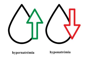 Hypernatremia1