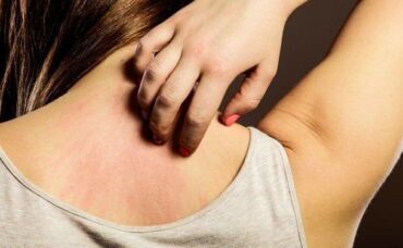 Vitamín B5 v jojobovom oleji pomáha pri liečbe kožných reakcií.