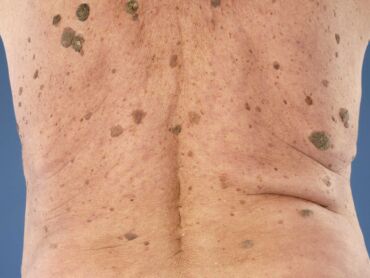 Seboroická keratóza, zdroj: skin-diseases.eu