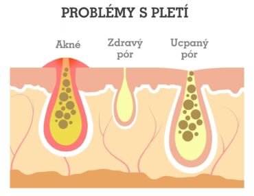Nadměrná tvorba kožního mazu může být způsobena geneticky i hormonálně.