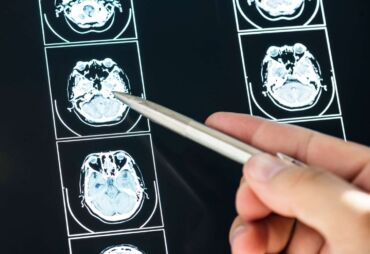 MRI mozgu
